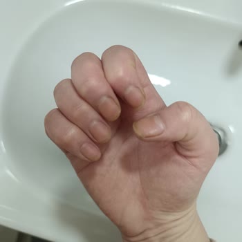 Glint Bitkisel Temizleyicide Öksürük Ve Tırnak Sararması Şikayeti