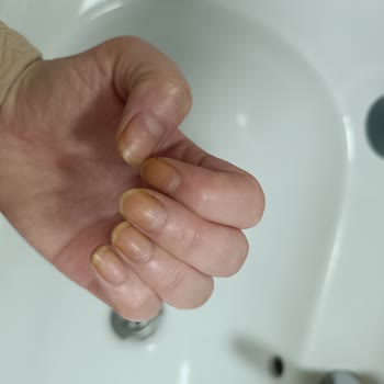 Glint Bitkisel Temizleyicide Öksürük Ve Tırnak Sararması Şikayeti