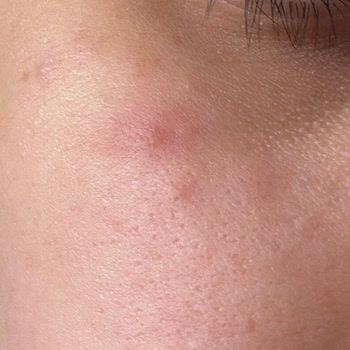 MR Oxy Fast Deterjanı Nedeniyle Alerjik Döküntü Ve Sağlık Mağduriyetim