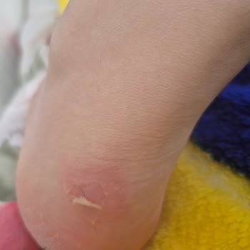 Ayakkabının Arka Bölümü Soyularak Deri Yara Bıraktı