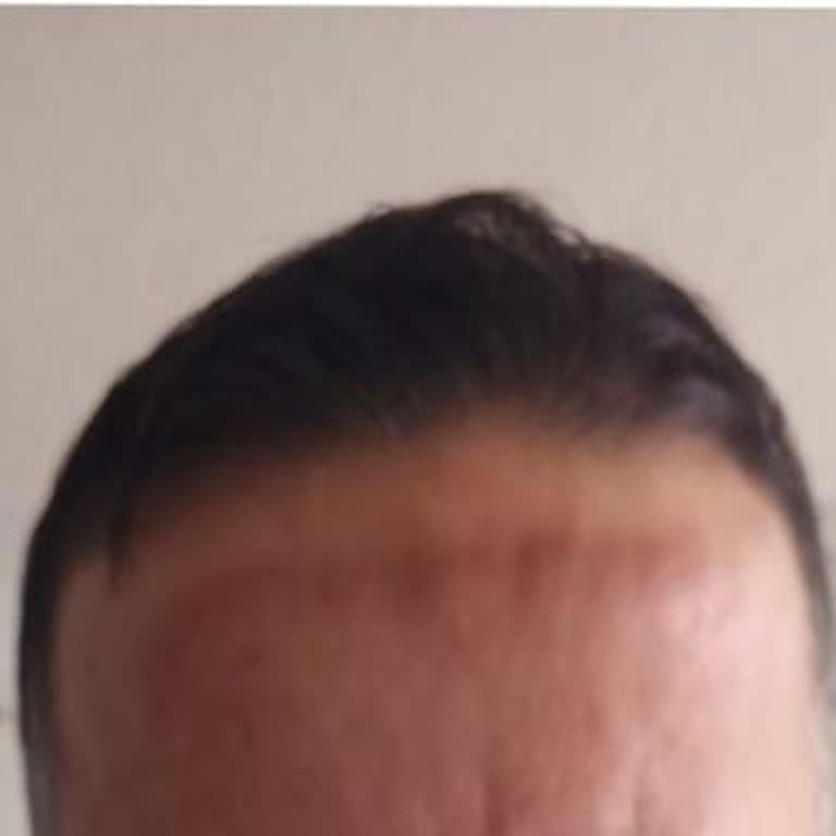 Lavinya Golden Güzellik Salonu’nda Dermapen Ve Cilt Bakımında Sonuç Vermedi 50 Bin TL Zarara Uğradım