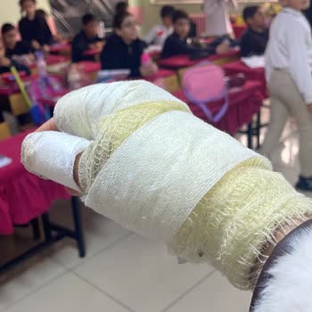 Patlayan Tencere Kapağı Nedeniyle Ciddi El Kesikliği Ve Sağlık Riski