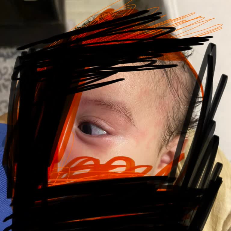 Yanıltıcı Kids Etiketi Ve Bebekte Alerjik Reaksiyon Nedeniyle Ürün İadesi Talebi