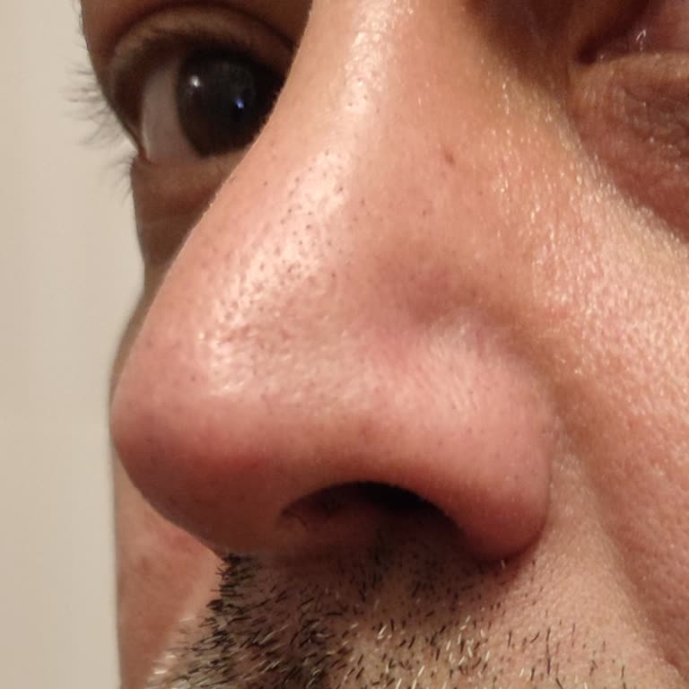 Üç Kez Burun Ameliyatı Sonrası Çarpık Burun Ve Hastane Çözüm Talebi