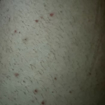 Epify Tüy Dökücü Kremde Cilt Yanması Ve Etkisizlik, İade Talebi