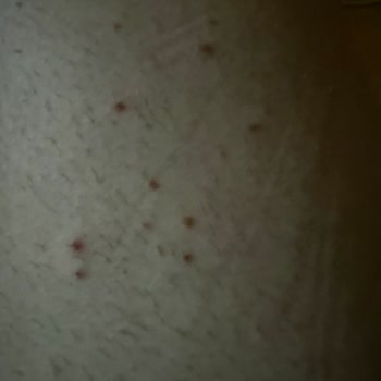 Epify Tüy Dökücü Kremde Cilt Yanması Ve Etkisizlik, İade Talebi