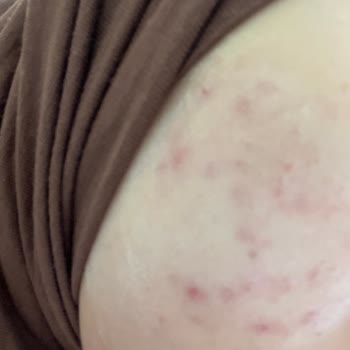 Purest Solutions Temizleme Jelinde Artan Sivilce Ve İrritasyon Nedeniyle İade Talebi