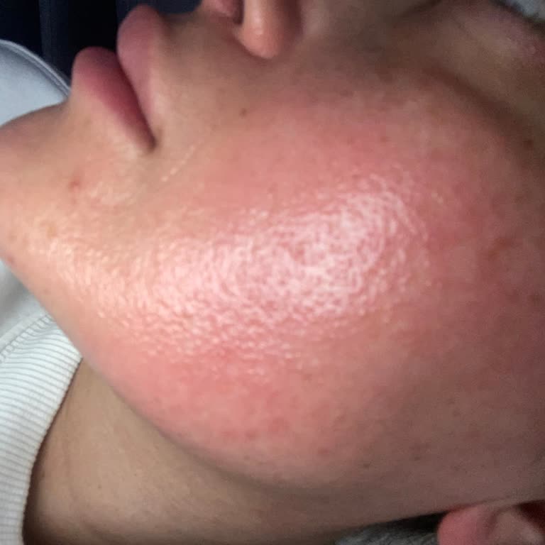 Cilt Yanması Ve Şişmesi Nedeniyle Ürün İadesi Ve Dermatolog Desteği Talebi