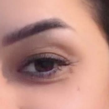 Botoks İşlemi Sonrası Asimetri Ve Şişlik İçin Ücret İadesi Talebi