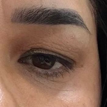 Botoks İşlemi Sonrası Asimetri Ve Şişlik İçin Ücret İadesi Talebi