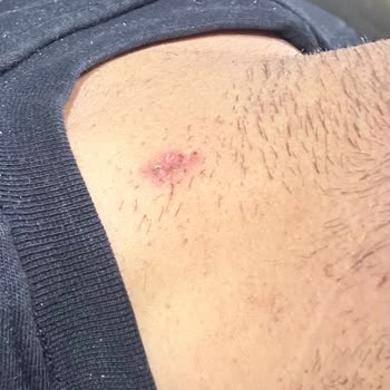 Lazer Epilasyon Garantisi İhlali Ve Yanık İzleri Üzerine Şikayet