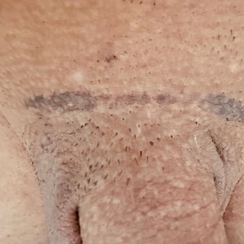 Lazer Epilasyon Garantisi İhlali Ve Yanık İzleri Üzerine Şikayet