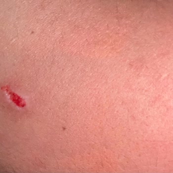 Lazer Epilasyon Garantisi İhlali Ve Yanık İzleri Üzerine Şikayet