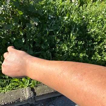 Lazer Epilasyon Garantisi İhlali Ve Yanık İzleri Üzerine Şikayet