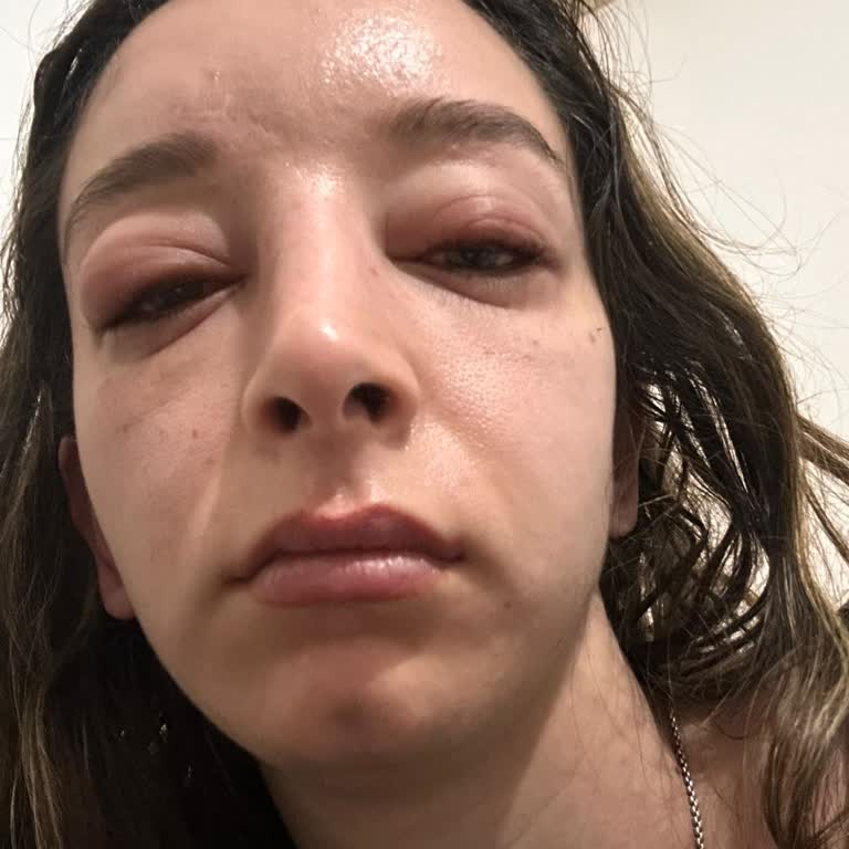 Grace & Glow Güzellik Salonu Kirpik Diplerimde, Gözümün İçinde Ciddi Şekilde Enfeksiyon Gelişti