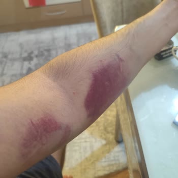 Kan Bağışı Sonrası Kollarımda Şiddetli Morarma Ve Ağrı