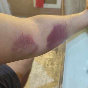 Kan Bağışı Sonrası Kollarımda Şiddetli Morarma Ve Ağrı