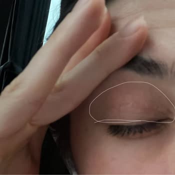 Watsons Frudia Blueberry Ürününden Yüz Ve Göz Kapaklarında Şiddetli Yanma