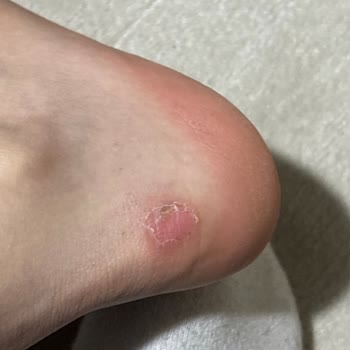 Puma Ayakkabısının Topuk Yarası Ve Boyner Mağazasının Sorumluluk Reddine Karşı İade Talebi