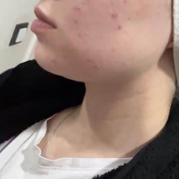 Estee Lauder Ürünlerinden Şiddetli Cilt Reaksiyonu Ve İade Talebi