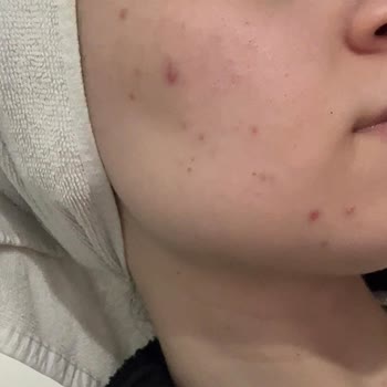 Estee Lauder Ürünlerinden Şiddetli Cilt Reaksiyonu Ve İade Talebi