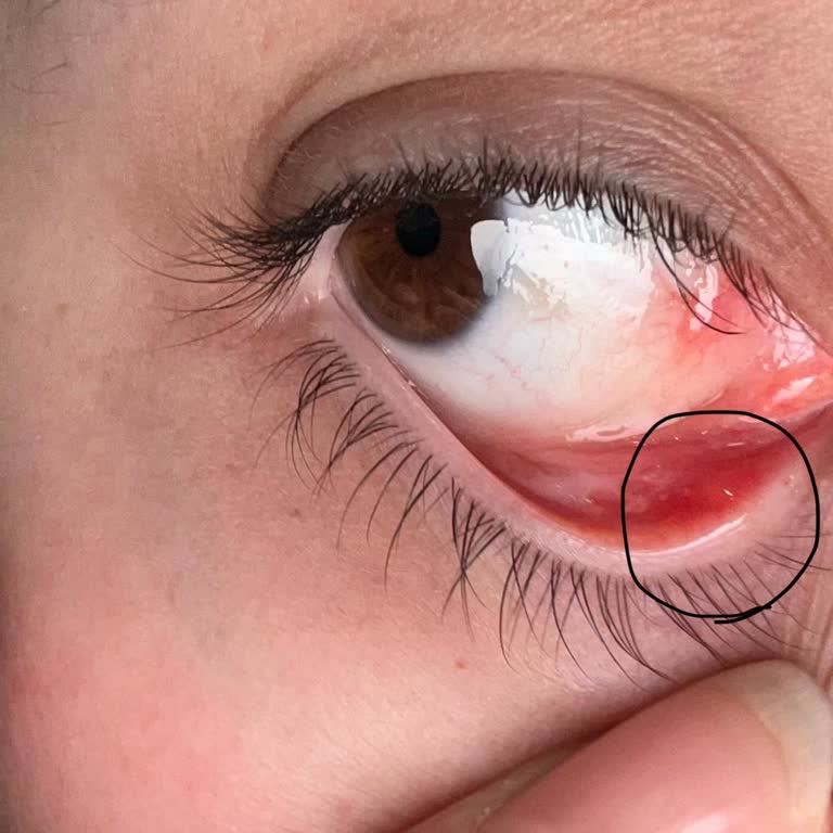 Estee Lauder Ürünlerinden Şiddetli Cilt Reaksiyonu Ve İade Talebi