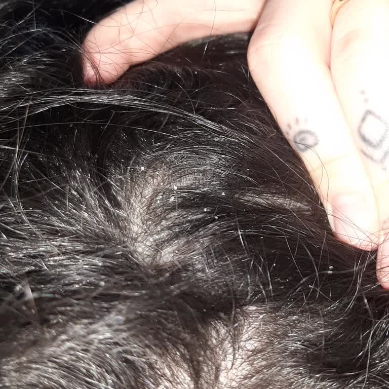 Yves Rocher Şampuanı Sonrası Kepek, Kaşıntı Ve Saç Dökülmesi