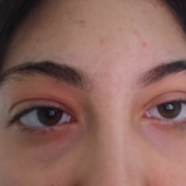 Sol Gözüm Şişti: Eye Glow Elixir Testeri İçin Acil İnceleme Talebi