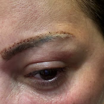 Esse Life İzmir Cildime Hasar Veren Dövme Silme Hizmetinde İade Reddi Ve Saygısız Davranış