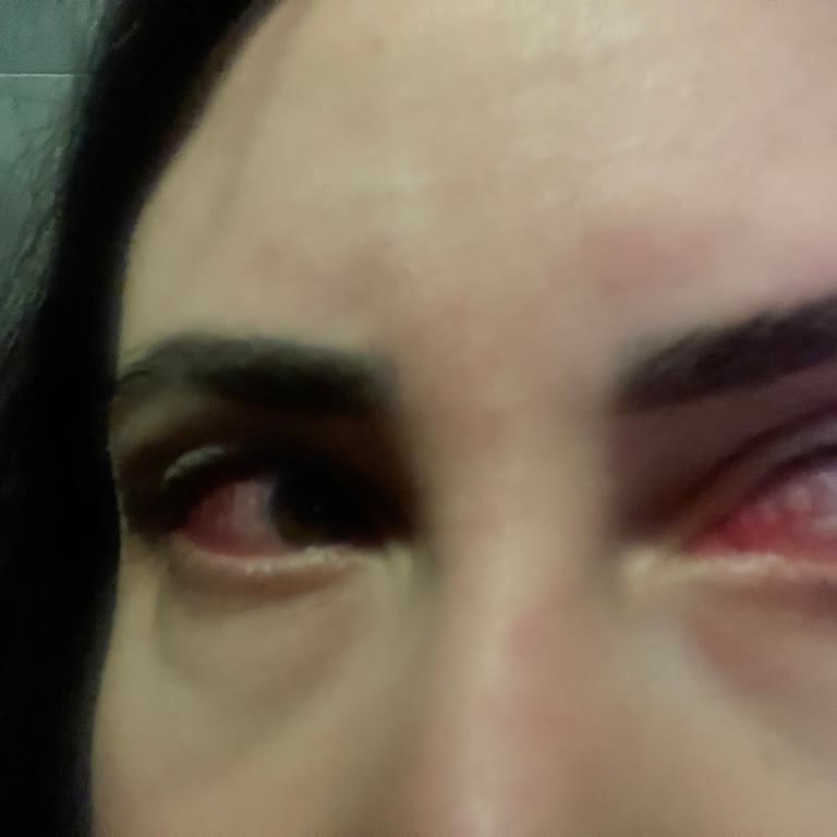 Flormar Göz Kalemi Şiddetli Yanma Ve Kızarıklığa Neden Oldu