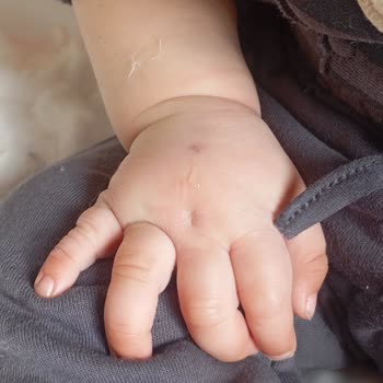 Özel Megapark Hastanesi Damar Yolu İhmalinden Kaynaklanan Çocuk Şişliğine Hastane Sessizliği