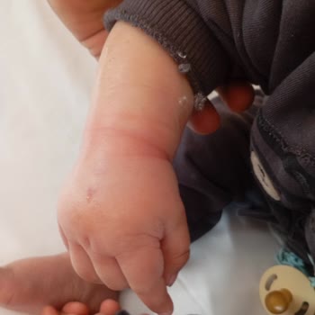 Özel Megapark Hastanesi Damar Yolu İhmalinden Kaynaklanan Çocuk Şişliğine Hastane Sessizliği