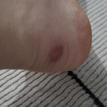 Skechers Ayakkabısında Üretim Hatası: Açılma Ve İade Talebi