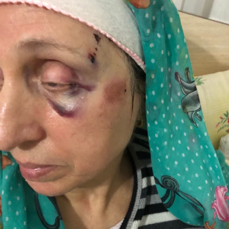 Denetimsiz İnşaatta Çimento Düşmesi 70 Yaşındaki Kadını Ağır Yaraladı