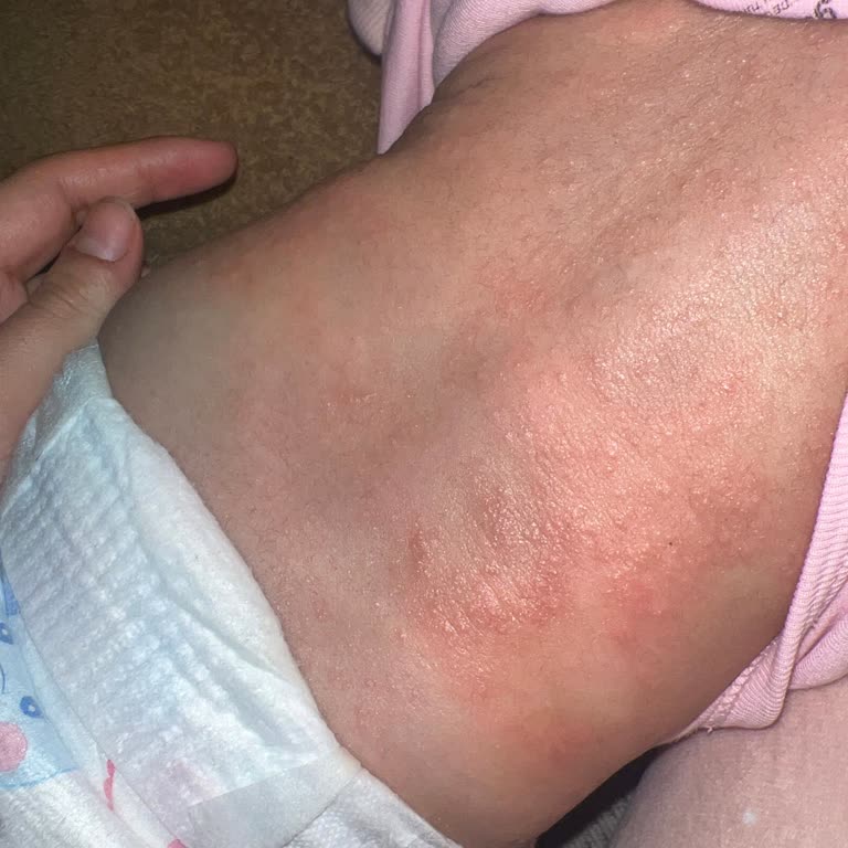 Hipp Mamadan Kaynaklanan Şiddetli Döküntü Ve Acil İnceleme Talebi