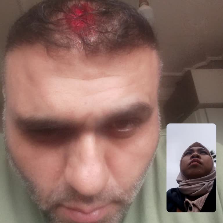 Saç Ekimi Sonrası İltihap, Kanama Ve Dökülme, Klinik Personelinin Küfürlü Tutumu