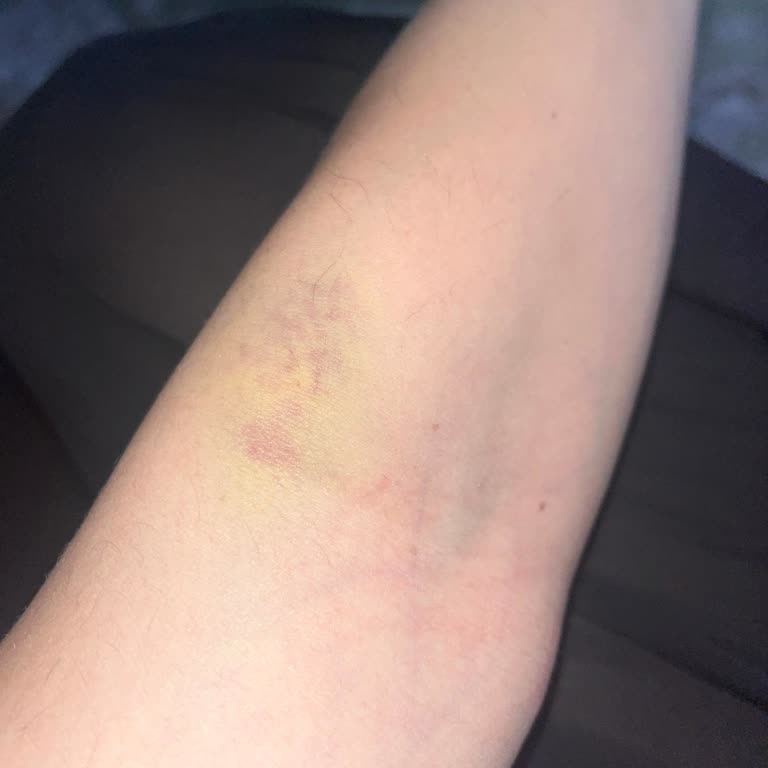 Zühre Ana Bromelain Şurup Kullanımından Şiddetli Kabızlık Ve Bağırsak Problemleri