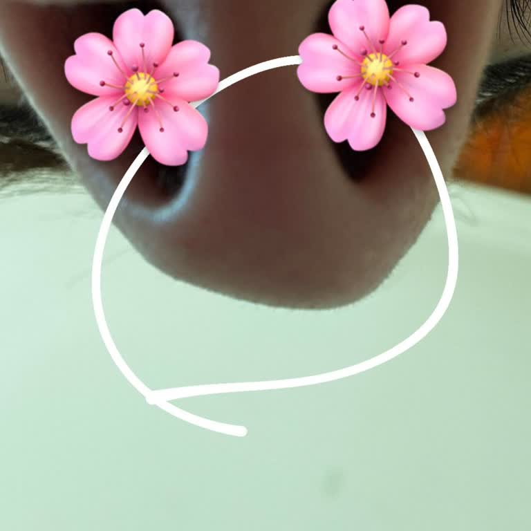 Burun Dolgusu Sonrası Artan Asimetri Ve Şişlik