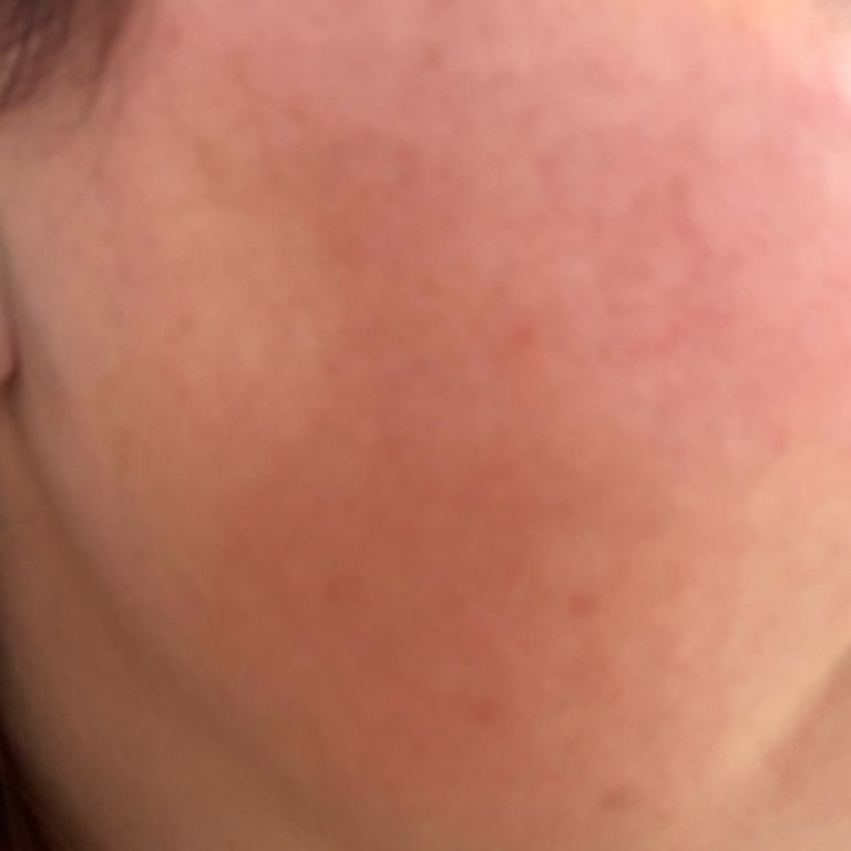 Cerave Yüz Kremi Kullanımında Şiddetli Yanma Ve Kızarma, İade Talebi