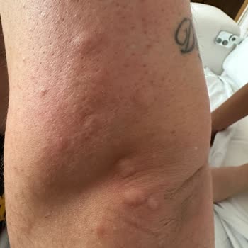 Pendik Medical Park Hastanesinde Böcekli Refakatçi Koltuğu Ve Hijyen İhmali