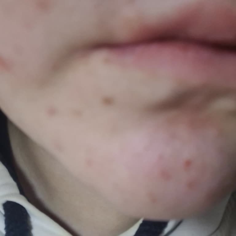 Luv It Akne Losyonu Ciltte Kabuklanma Ve Tahrişe Yol Açtı İade İstiyorum