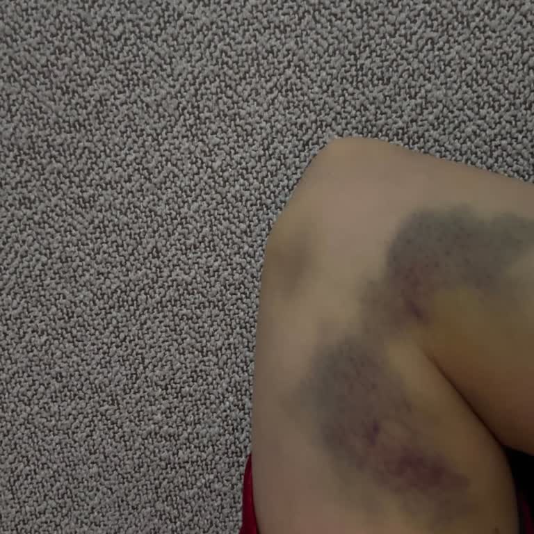 Dr. Bilge Canpolat Dermatoloji Kliniği 3 Gün Boyunca Kolumu Hareket Ettiremedim