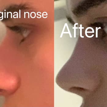 Söz Verilen Burun Şekli Gerçekleşmedi, İki Yıl Boyunca Kanama Ve Cevapsız Şikayet