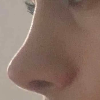 Söz Verilen Burun Şekli Gerçekleşmedi, İki Yıl Boyunca Kanama Ve Cevapsız Şikayet