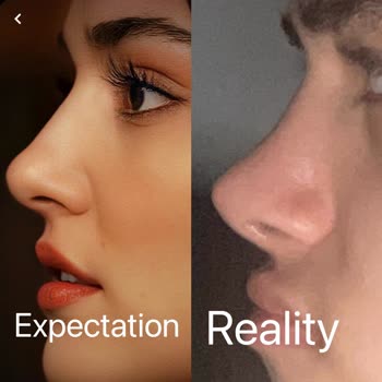 Söz Verilen Burun Şekli Gerçekleşmedi, İki Yıl Boyunca Kanama Ve Cevapsız Şikayet