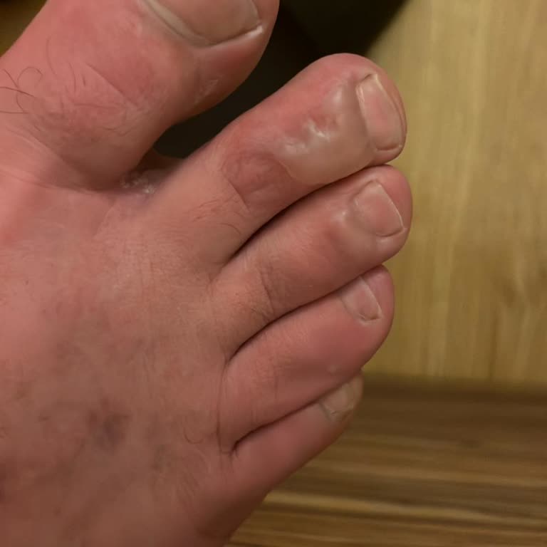 Stanley Patlayan Termos Ayağımı Yaktı