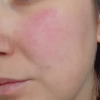 Brimoder Jelinde Şiddetli Kızarıklık Ve Yanma Nedeniyle Ücret İadesi Talebi