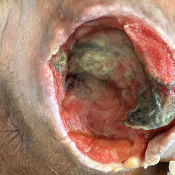 Yüzde 96 Engelli Yatalak Oğlumun İnsanlık Dışı Koşullarda Tutulması