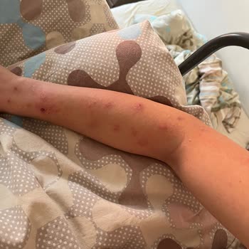 Tahta Kurusu İstilası Ve Yetersiz İlaclama Yurt Öğrencilerini Sağlık Riski Altına Sokuyor