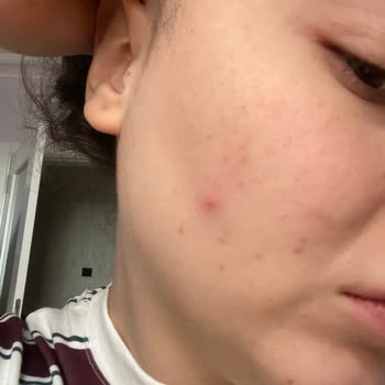 Bioderma Atoderm Cream Ultra’da Yüzde Şiddetli Komedon Ve Sivilcelenme